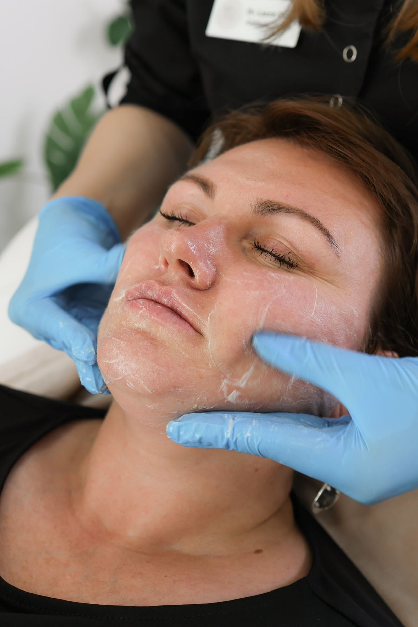 How Obagi Nu-Derm Skin System works for melasma in Kingston Upon Thames Surrey London