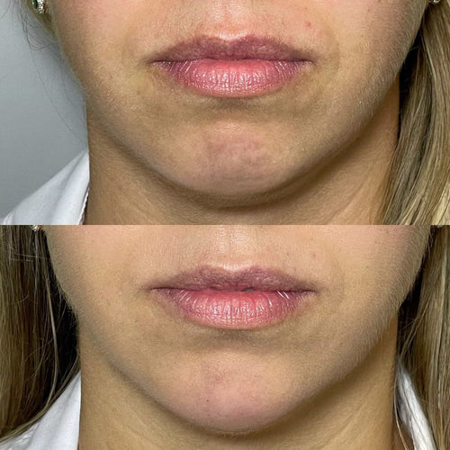 How To Speed Up Lip Filler Recovery