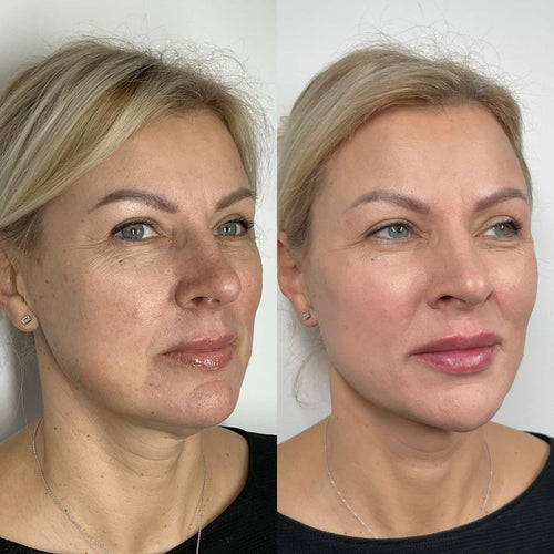 How Long Does It Take For The Swelling To Go Down After Lip Filler