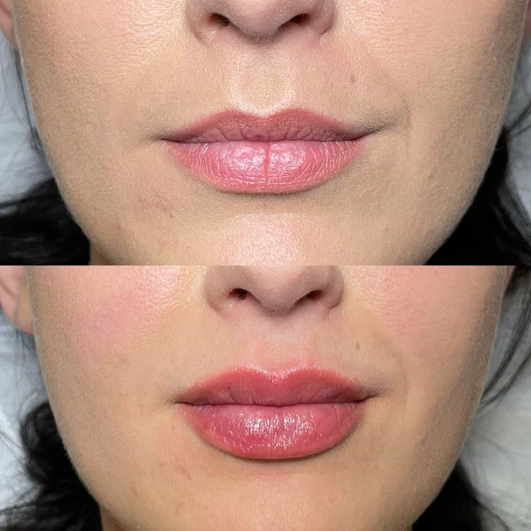 Are Lip Fillers Safe? A Comprehensive Guide for UK Residents