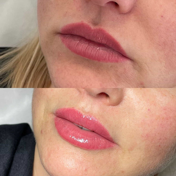 Are Lip Fillers Safe? A Comprehensive Guide for UK Residents