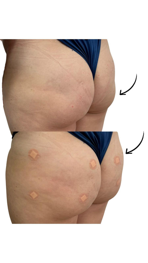 How to Select the Right Practitioner for a Non-Surgical Bum Lift