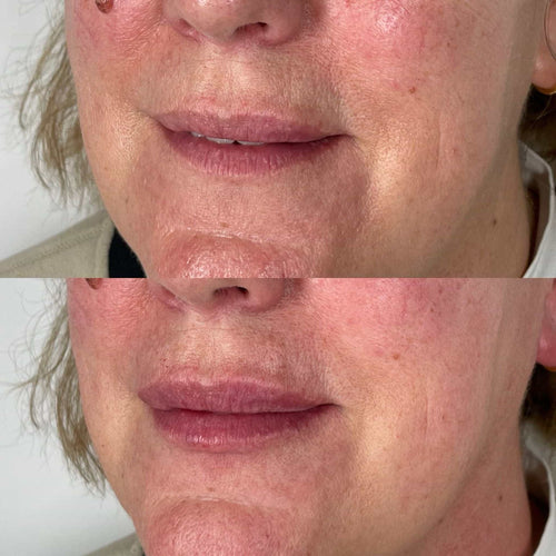 Where is filler injected for marionette lines?